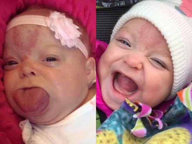 Hội chứng Beckwith-Wiedemann - Hình ảnh minh họa